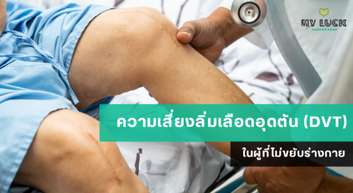 ความเสี่ยงลิ่มเลือดอุดตัน (DVT) ในผู้ที่ไม่ขยับร่างกาย